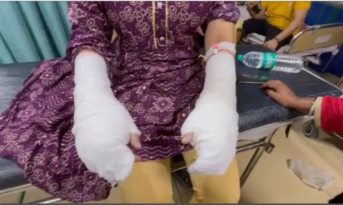 दिल्ली में ‘एसिड अटैक’ का मामला निकला फर्जी, लड़की ने आपसी विवाद में गढ़ी कहानी